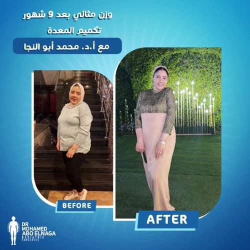 تجاربكم مع تكميم المعدة 4